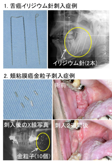舌癌イリジウム針刺入症例、頬粘膜癌金粒子刺入症例